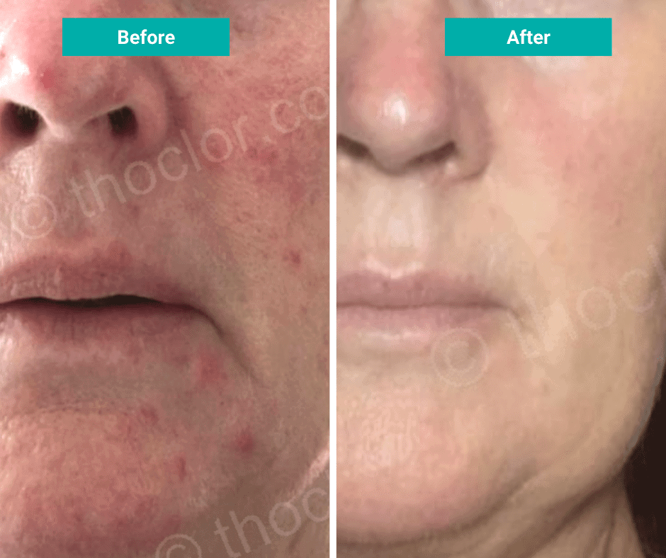 rosacea before after thoclor labs